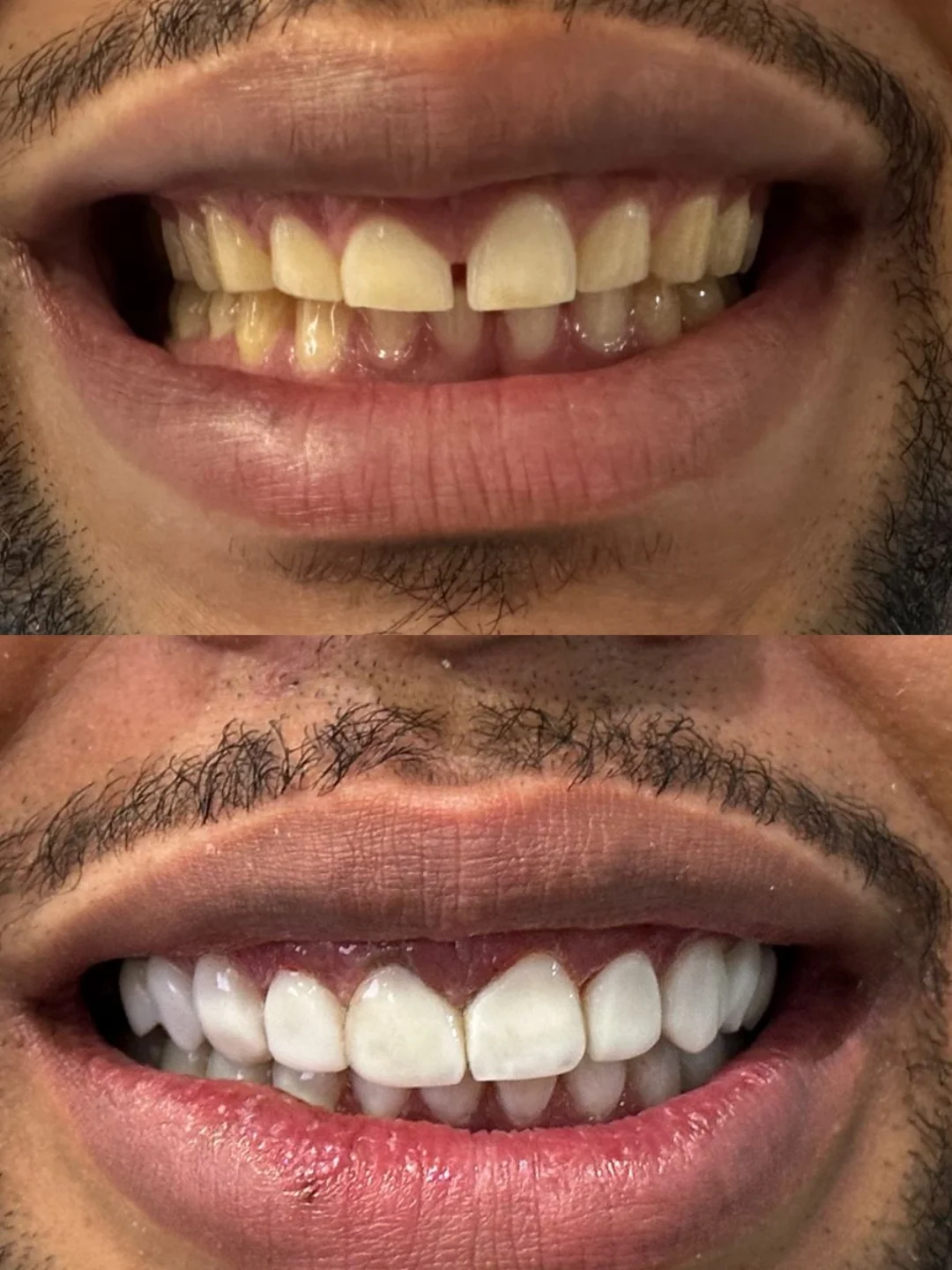 Clareamento Dental — antes e depois